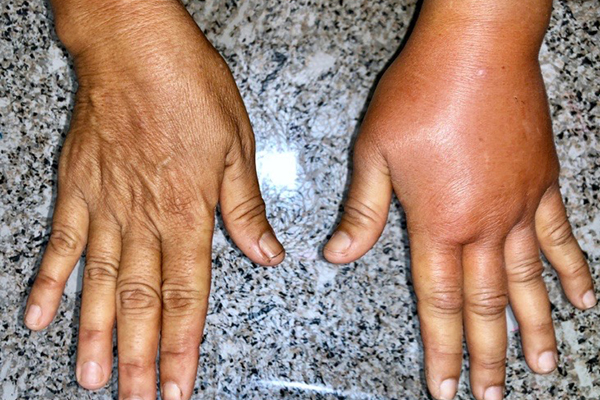 Example of lymphedema swelling caused by lymphatic fluid buildup.